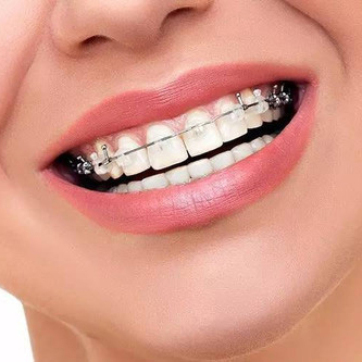 牙齿矫正对口腔的潜在影响：专业解读与护理建议